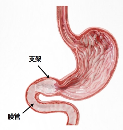 胃转流支架示意图2.png 胃转流支架示意图2.png